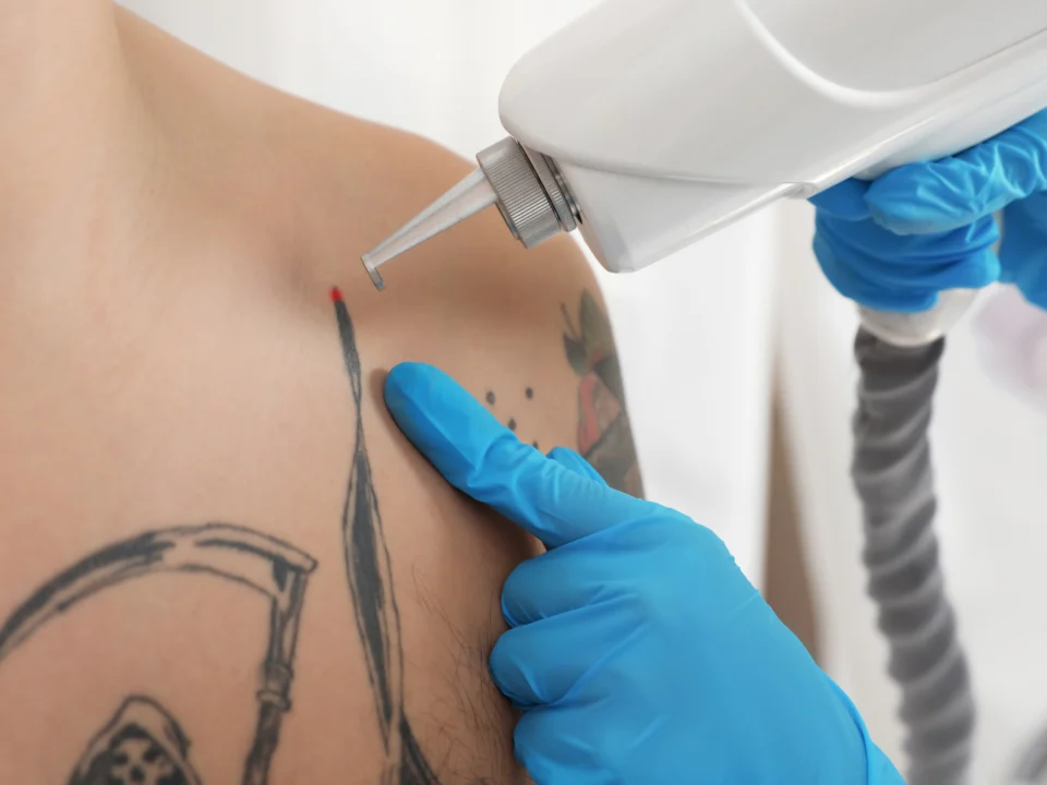 2. Large tattoo removal fading results over sessions photos