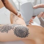 can you do laser hair removal over tattoos