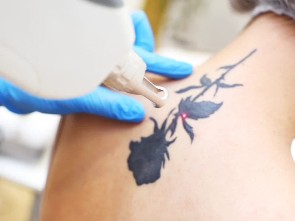 Colored ink tattoo removal before and after comparison