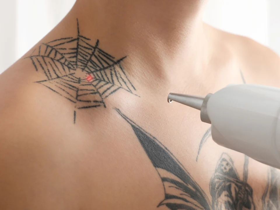 ink color impact on laser tattoo removal cost black vs color