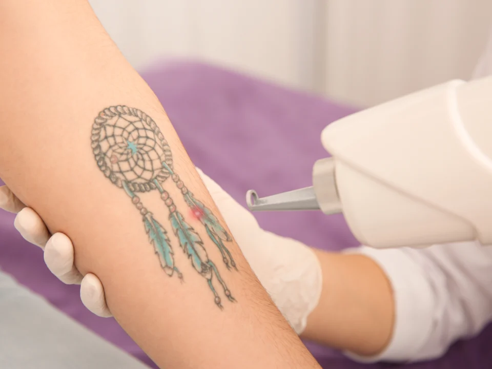 laser tattoo removal cost before and after results