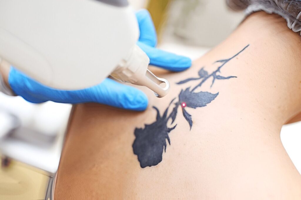 laser tattoo removal process over multiple sessions