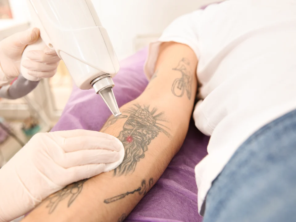 tattoo-removal-after-3-sessions