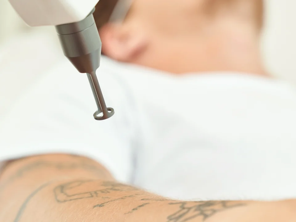 Before and after tattoo removal after 6 laser treatments