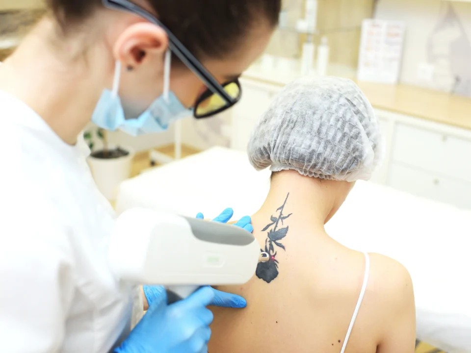 tattoo-removal-skin-healing-after