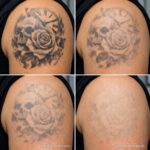 tattoo removal sessions progress before after multiple treatments